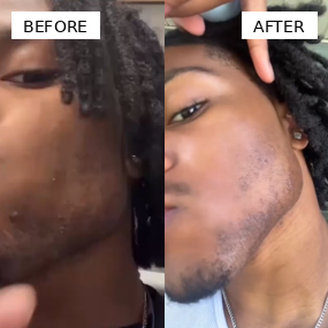 CleanCut™ Ingrown Tonic Roller