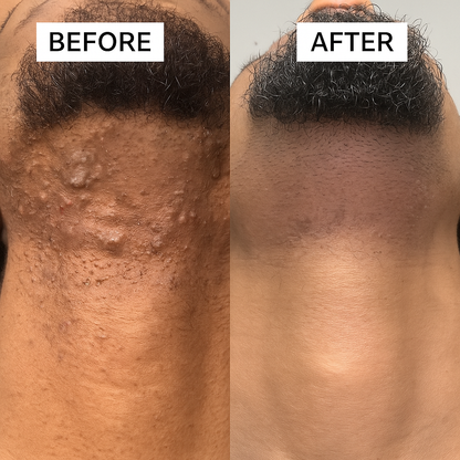 CleanCut™ Ingrown Tonic Roller